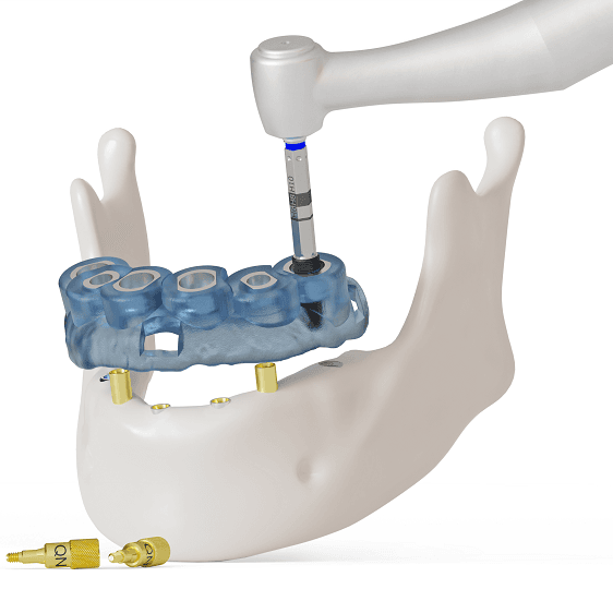 Guided surgery for the edentulous jaw